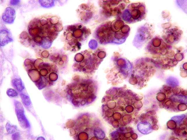 Oito novos laudos confirmam histoplasmose no Santa Rita